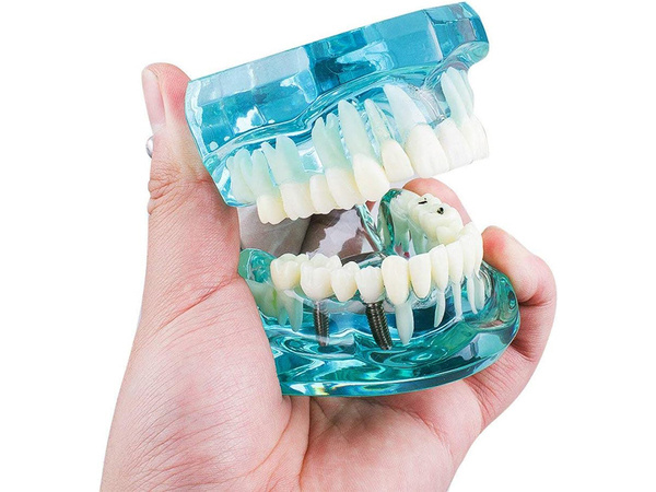 Zubní model čelist zuby zubní implantáty