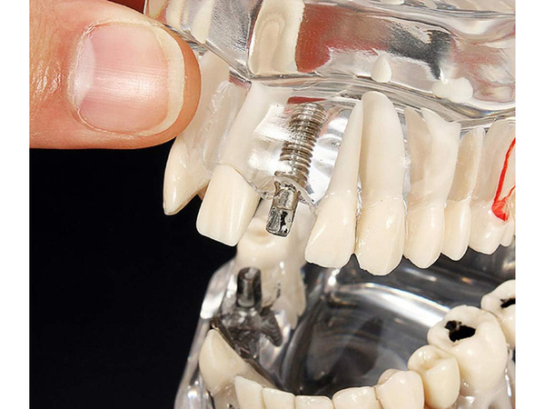 Zubní model čelist zuby zubní implantáty