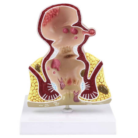 Anatomical model of anus hemorrhoids magnification 5x