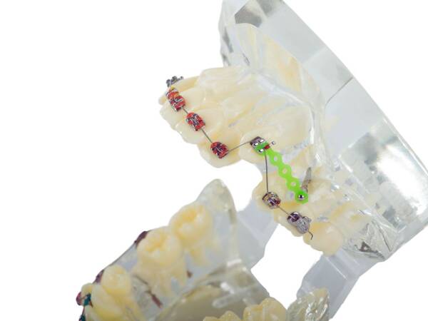 Dental model jaw teeth teeth braces