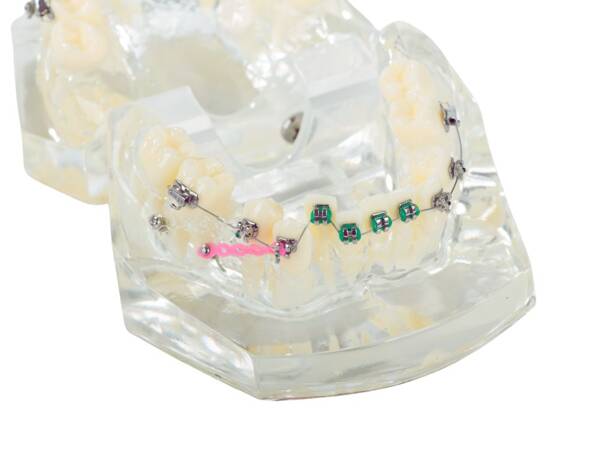 Dental model jaw teeth teeth braces