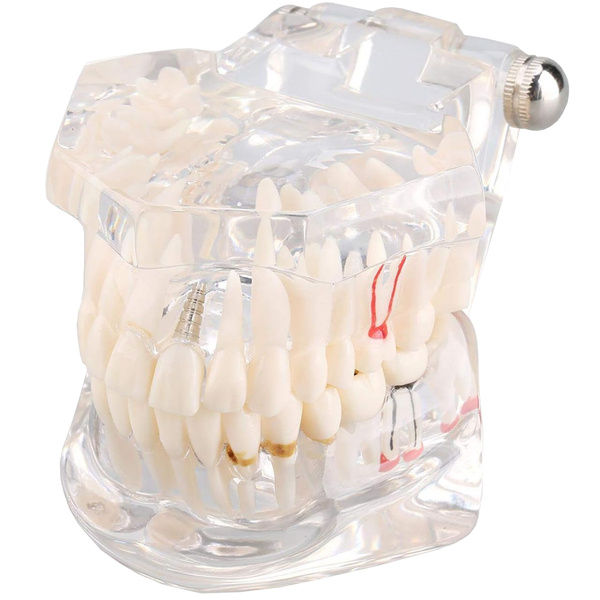 Dental model jaw teeth teeth implants