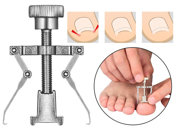 Kit für eingewachsene zehennägel zehennagel- und handnagelknipser