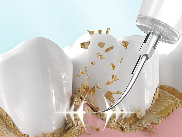 Détartreur dentaire à ultrasons pour le nettoyage des dents et l'élimination du tartre