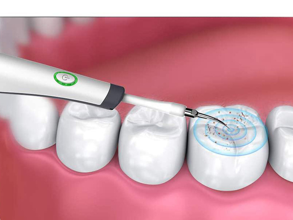 Escarificador dental ultrasónico para limpieza dental eliminación de sarro