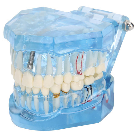 Modelo dental dientes mandíbula implantes dentales