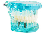Dental model jaw teeth teeth implants