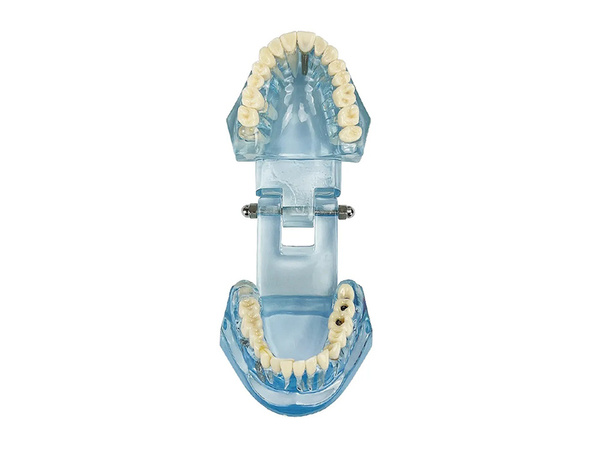 Modelo dental dientes mandíbula implantes dentales