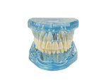 Modelo dental dientes mandíbula implantes dentales