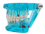 Modelo dental dientes mandíbula implantes dentales