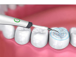 Escarificador dental ultrasónico para limpieza dental eliminación de sarro