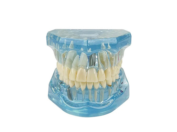 Modelo dental dientes mandíbula implantes dentales