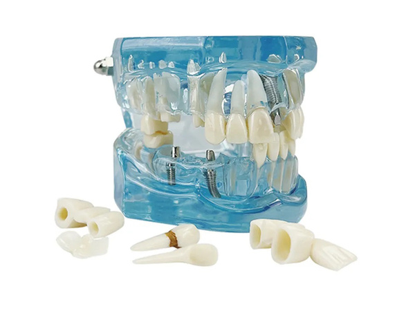 Modelo dental dientes mandíbula implantes dentales