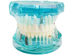 Modelo dental dientes mandíbula implantes dentales