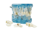 Modelo dental dientes mandíbula implantes dentales