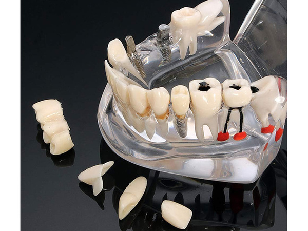 Fogászati modell állkapocs fogak fogak implantátumok