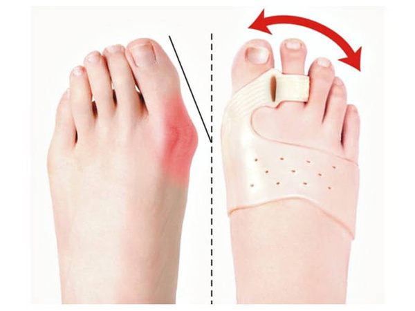 Kojų pirštų atskyriklis hallux valgus gelio pleišto magnetas
