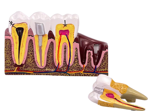 Modelo anatómico de diente dental educativo sección transversal diente extraíble