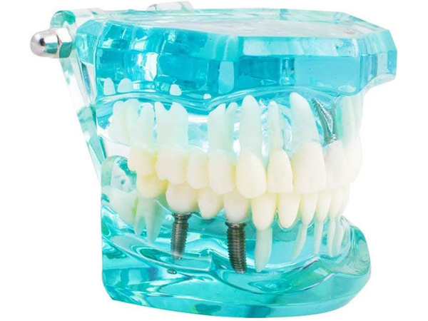 Modelo dental dientes mandíbula implantes dentales