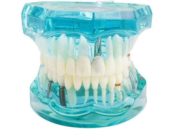 Dental model jaw teeth teeth implants