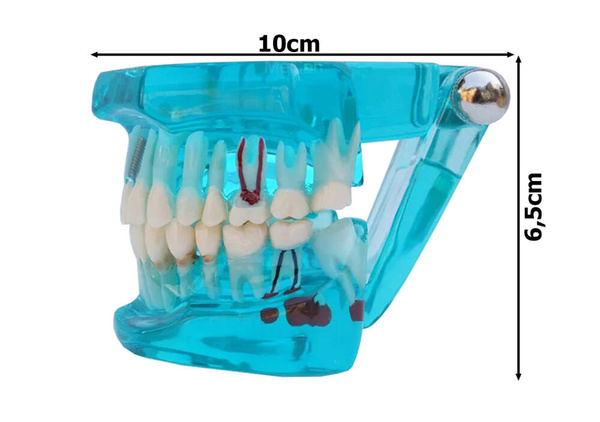 Modelo dental dientes mandíbula implantes dentales