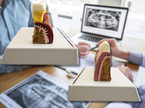 Modelo anatómico de diente dental educativo sección transversal diente extraíble