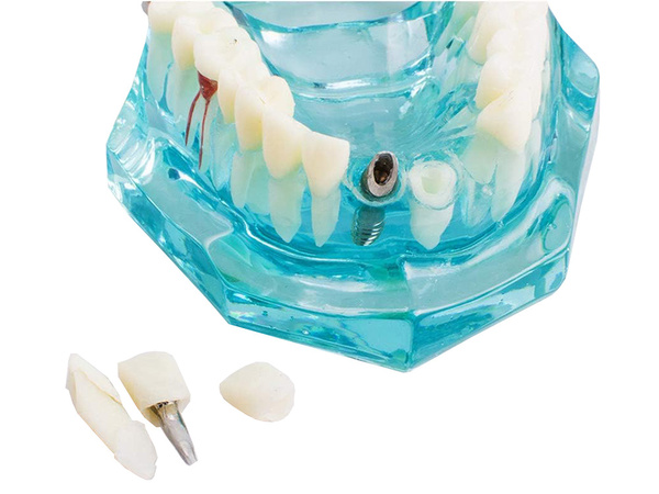 Fogászati modell állkapocs fogak fogak implantátumok
