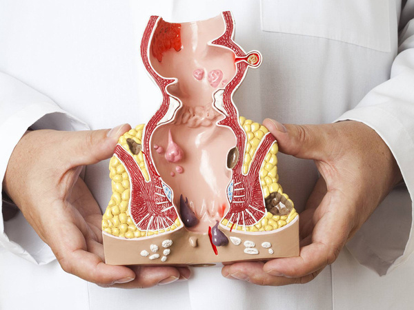 Modelo anatomico de ano hemorroides aumento 5x