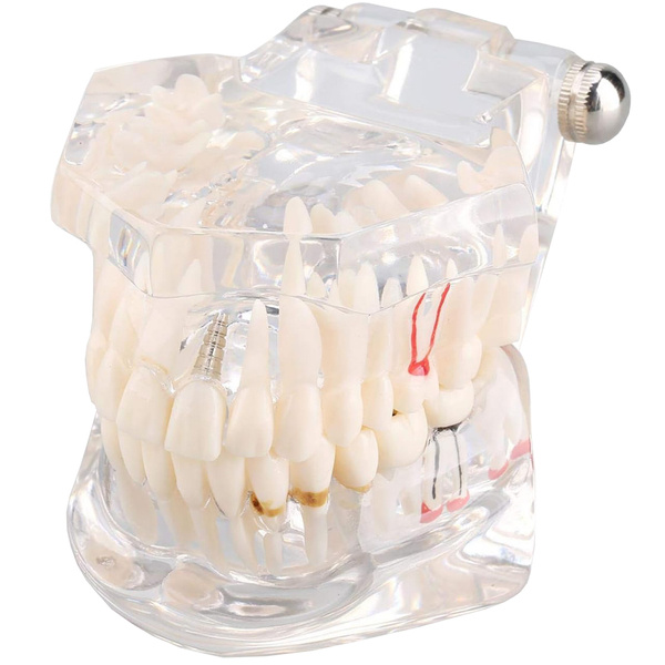 Modelo dental dientes mandíbula implantes dentales