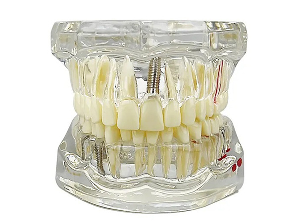 Modelo dental dientes mandíbula implantes dentales