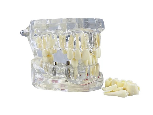 Modelo dental dientes mandíbula implantes dentales