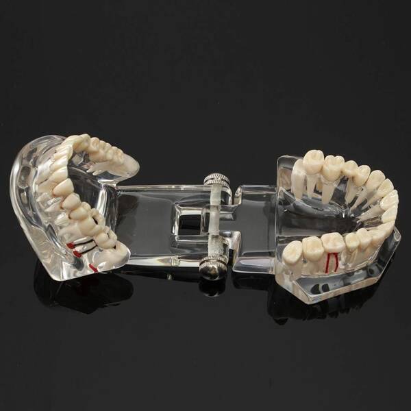 Modelo dental dientes mandíbula implantes dentales