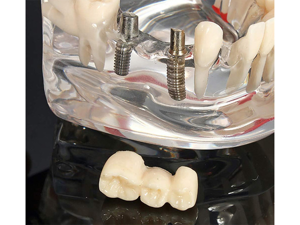 Modelo dental dientes mandíbula implantes dentales