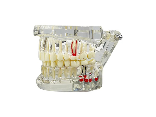 Modelo dental dientes mandíbula implantes dentales