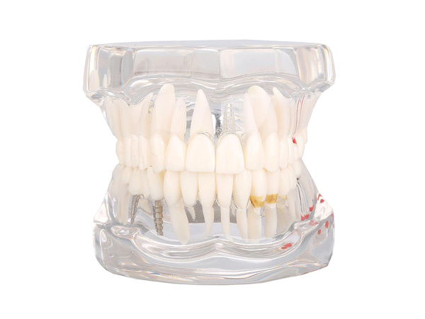 Modelo dental dientes mandíbula implantes dentales