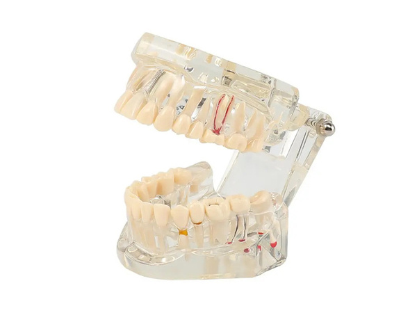 Modelo dental dientes mandíbula implantes dentales