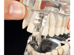 Modelo dental dientes mandíbula implantes dentales