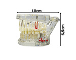 Modelo dental dientes mandíbula implantes dentales